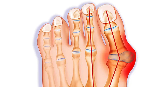 Free Workout, Week 8: Bunions